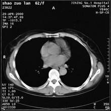 非感染性心内膜炎
