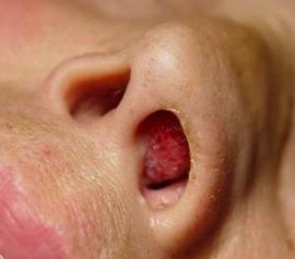 小儿鼻息肉_360百科