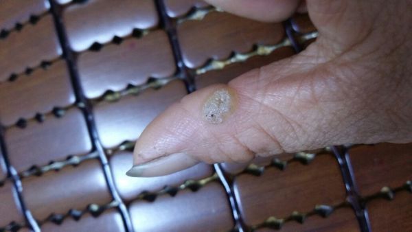 求助医生我朋友拇指上长了一个白色透明的硬包