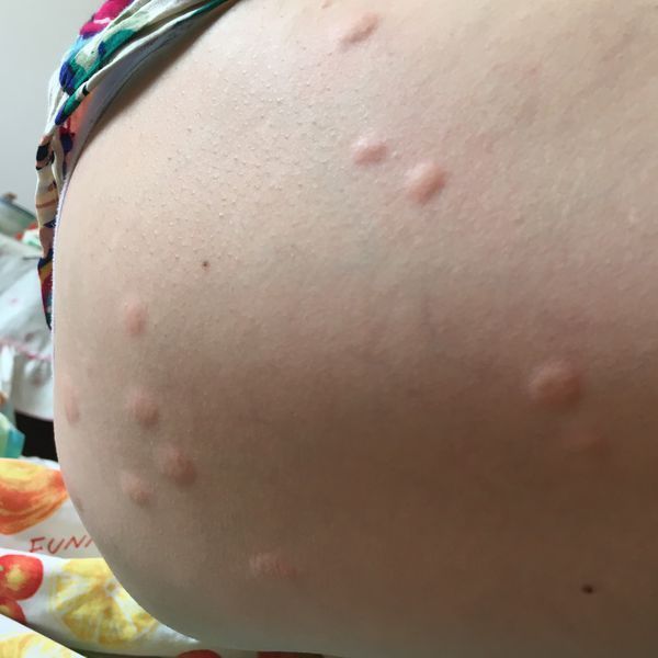 皮肤上起了包,不知道是虫子咬的还是自己起的