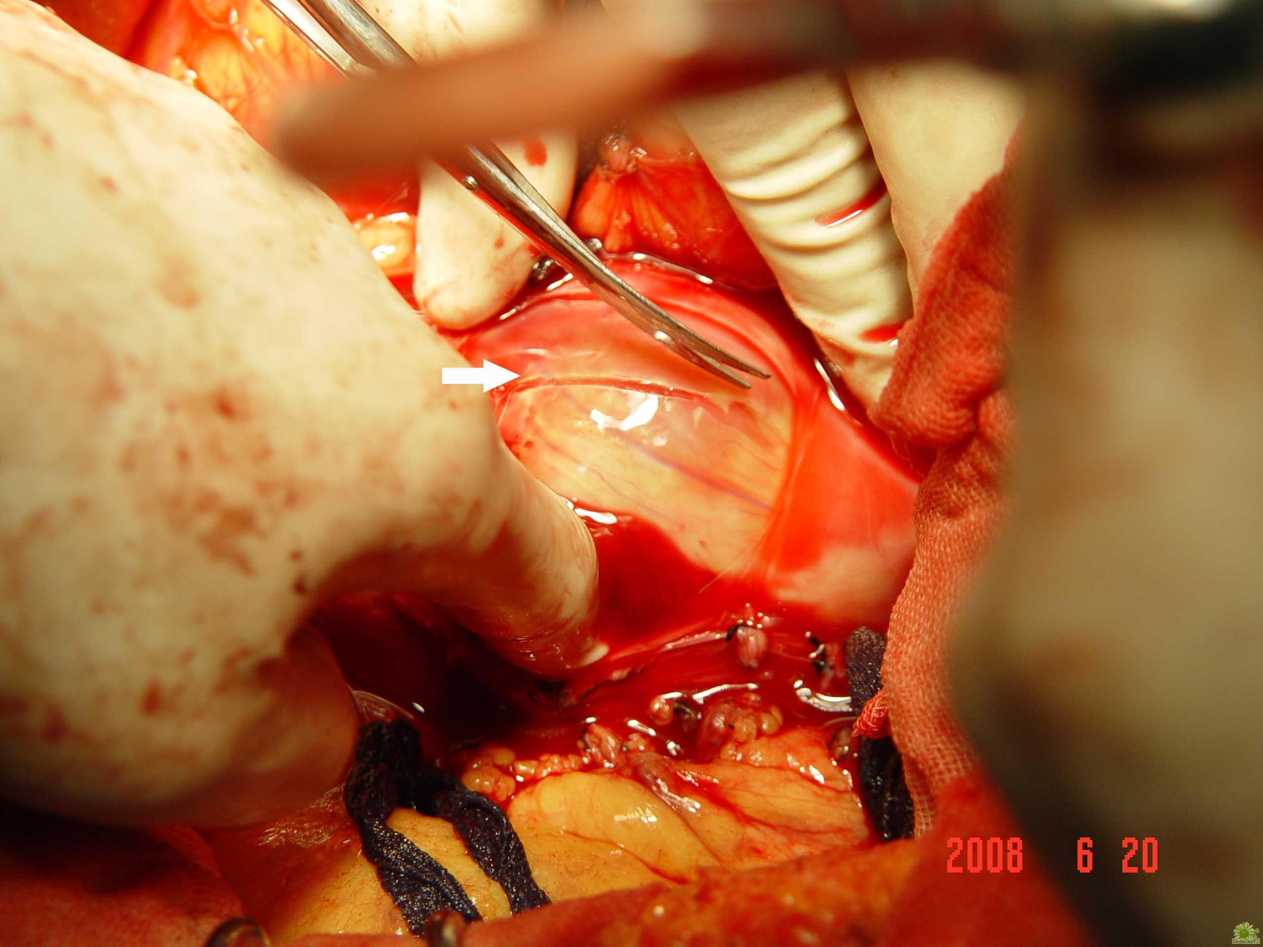 左肾切除后,日常生活中注意什么